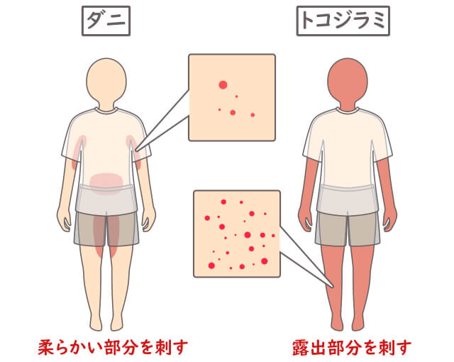 ダニ トコジラミ　刺される場所　違い