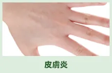 皮膚炎